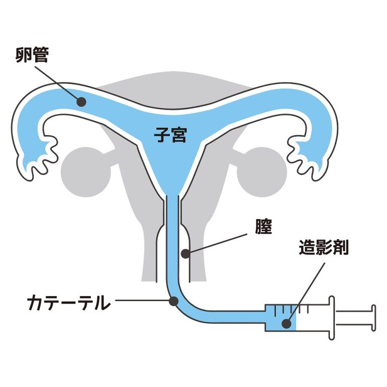 卵 管 造影 検査 と 通 水 検査 の 違い
